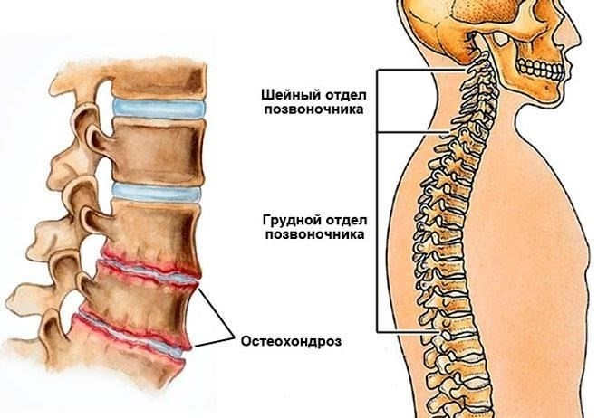 Как доказать, что у вас остеохондроз?